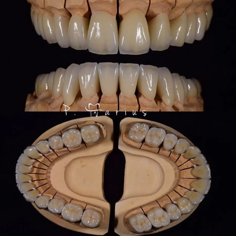 Arcade dentare realizate în laboratorul Art Dent
