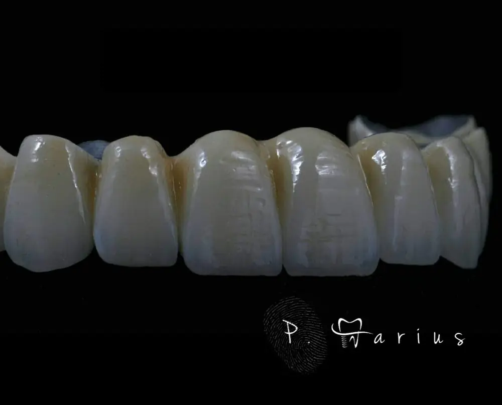 Lucrare fixă din ceramică